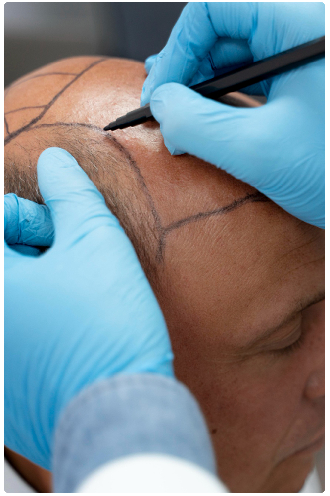 Certificate in Hair Transplant